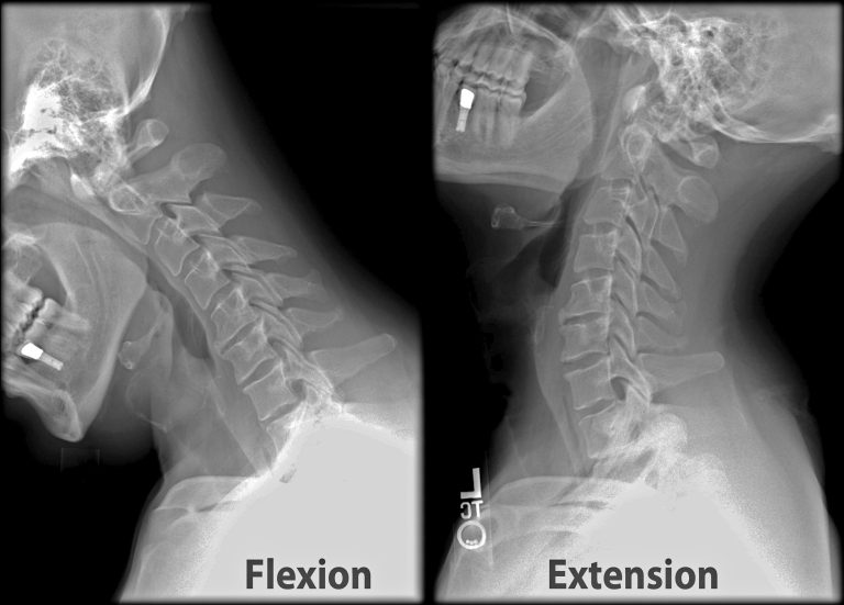 Biomecánica de los accidentes de tráfico: causas, lesiones y prevención