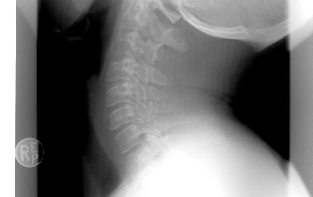 ¿Se puede conducir con latigazo cervical?
